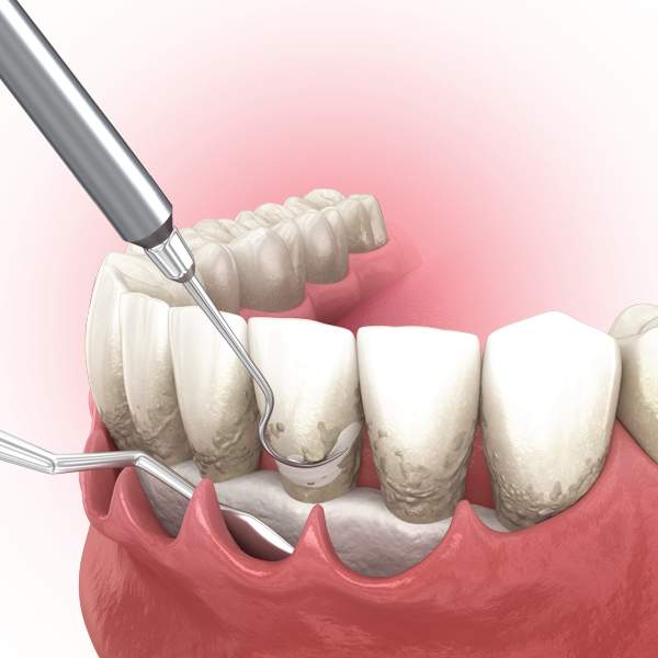 Periodontal Deep Cleaning - Houston, TX: Garden Oaks Dental