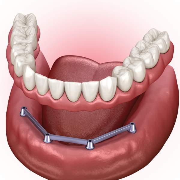 Temporary Dentures vs. Permanent Dentures - Pickett Family Dental