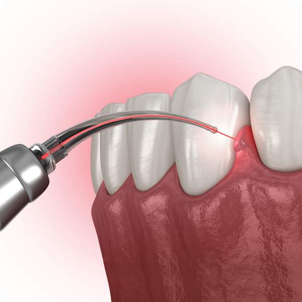 Gum Laser Therapy