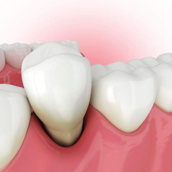 Tooth Extractions