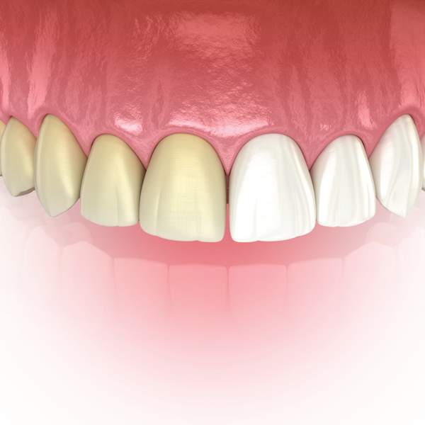 Teeth Whitening