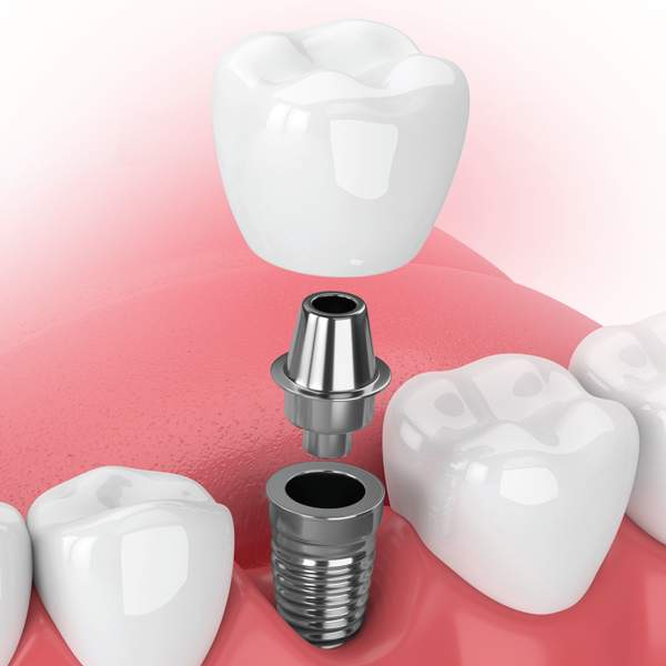 Dental Implant Single