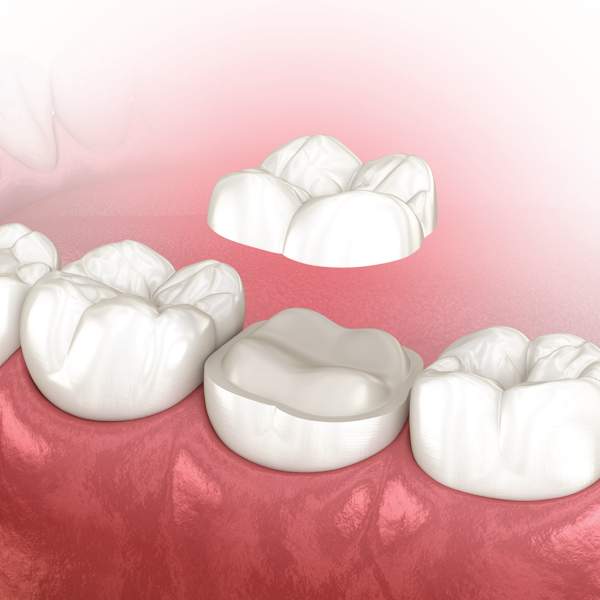 Dental Crown