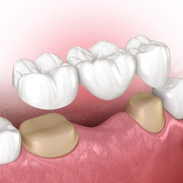Dental Bridge