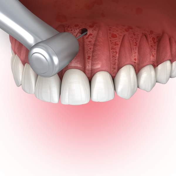 Endodontist Litchfield Park AZ Root Canal Glendale Endodontics Good Year