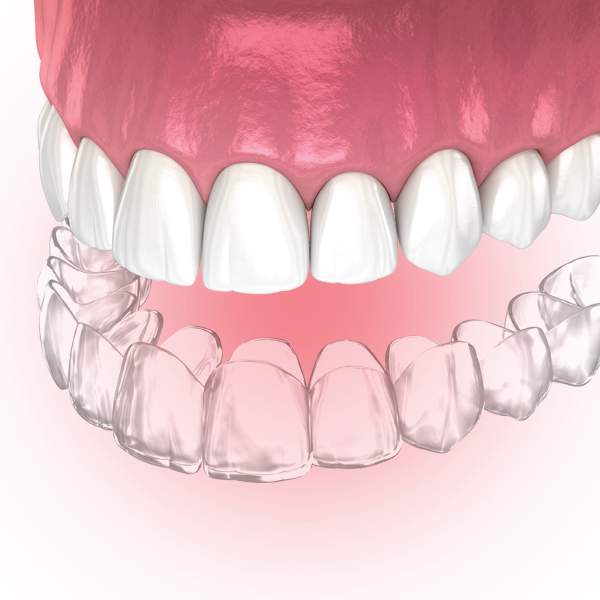 Clear Aligners