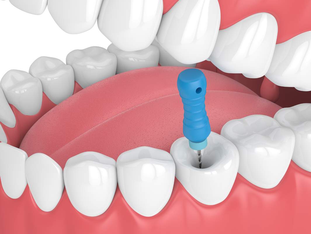 Endodontics Salem MA, Endodontist