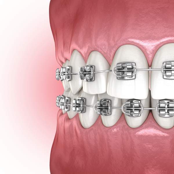 Orthodontist Somerville NJ Braces Invisalign Orthodontics