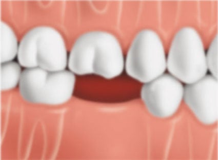 Tooth with a gap