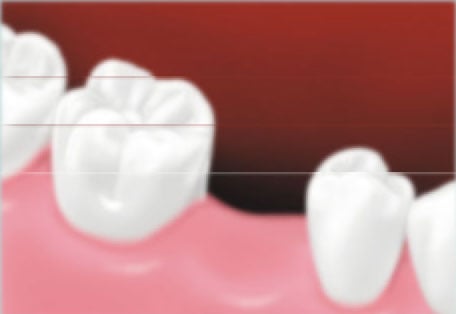 Missing tooth