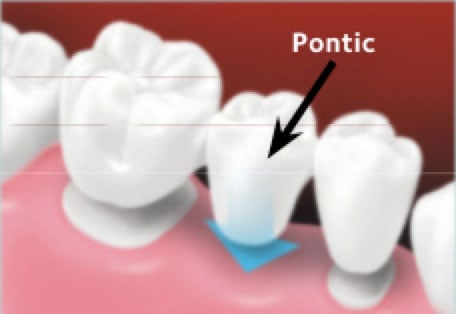 The custom-made bridge is placed over the prepared teeth.