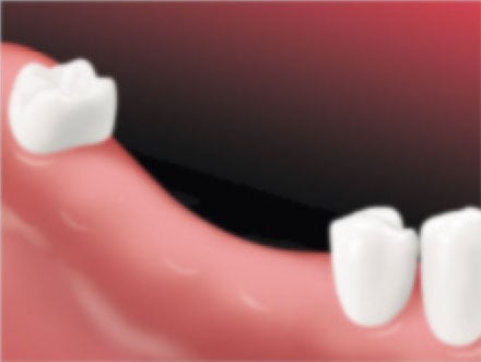 Missing teeth