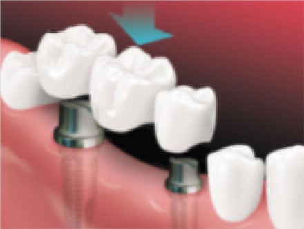 A bridge is placed on implants