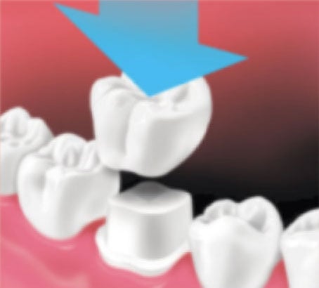 Dental Crown being placed on tooth