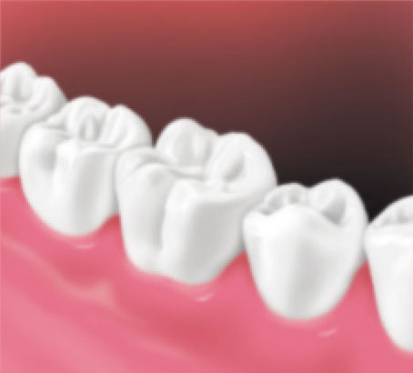 Perfect tooth after crown placement