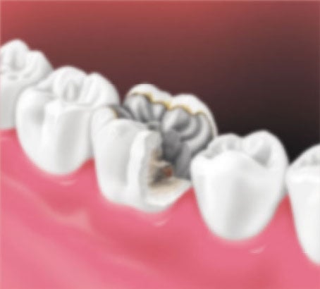 broken and decayed tooth