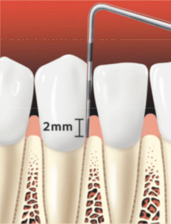 Periodontal probe of healthy gums.