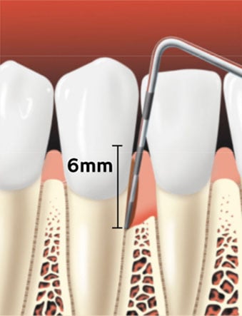 Periodontal probe in a periodontal pocket
