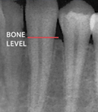 X-ray showing supporting bone