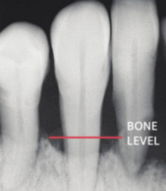 X-ray showing periodontal bone loss