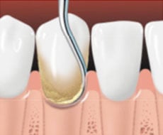 Image of teeth being scaled