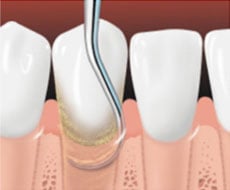 Image of teeth being root planned