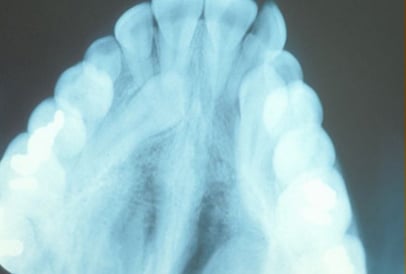 Impacted Canine X-Ray