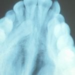 Impacted Canine X-Ray