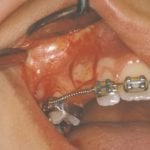 La exposición quirúrgica de dientes caninos