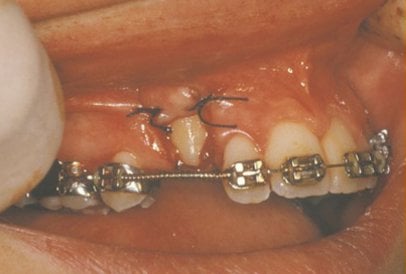 Impacted Canine Tooth Exposure