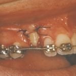 La exposición canina de dientes impactados