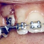 Tirando del diente canino hacia abajo con aparatos ortopédicos
