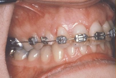 Corrección exitosa de mordida en dientes caninos