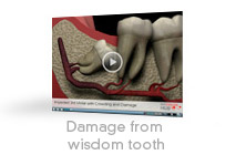 Impacted 3rd Molar - Crowding and Damage video