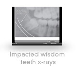 Impacted Wisdom Teeth X-Rays video