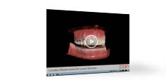 Lower Denture Implants Video
