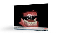Upper Denture Implants Video