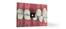 Why Replace a Missing Tooth (Spanish) Video
