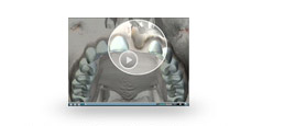 Bone Grafting After Tooth Loss video