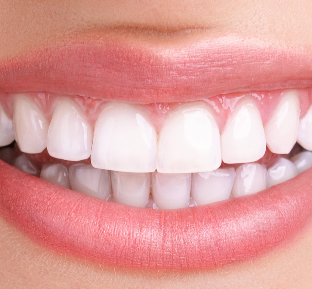 after teeth whitening