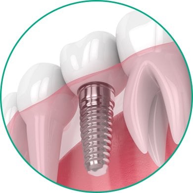 illustration of Dental Implants