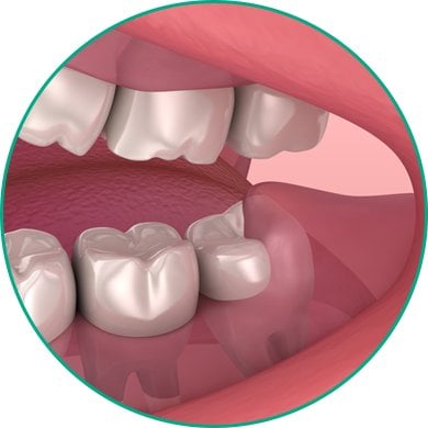 illustration of Wisdom Teeth Removal