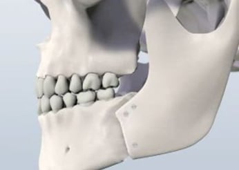 Image of a jaw